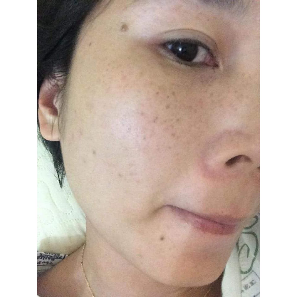 CAO NÁM MAGIC SKIN cao nám Royal Melasma Plus 👍  ngừa nám tàn nhang ✔ Size 13g