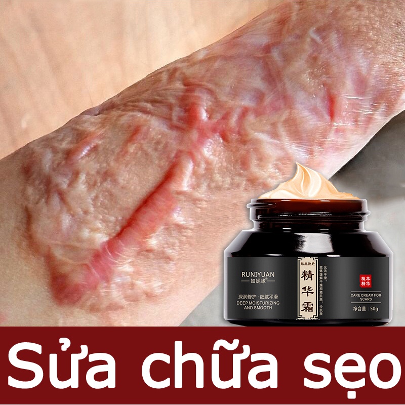 Kem bôi xóa mờ sẹo lồi lõm lâu năm , rạn da sau sinh, vết thâm do mụn cải thiện hiệu quả giúp da láng mịn