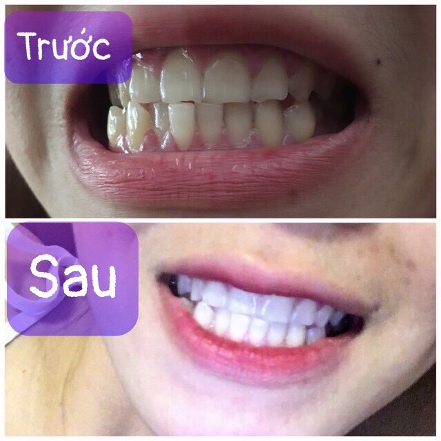 Máy làm Trắng Răng Beautiful White teeth bao giá toàn quốc. (HÀNG LOẠI 1) máy ngậm trắng răng,