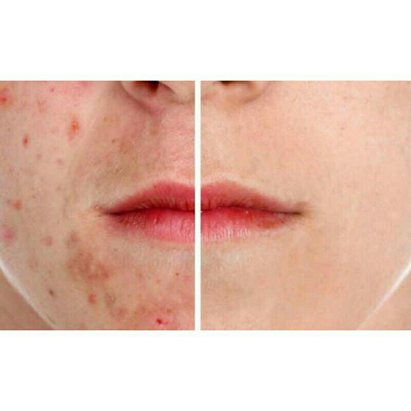 Bôi ngoài da Hiteen bôi mụn(10g) | BigBuy360 - bigbuy360.vn