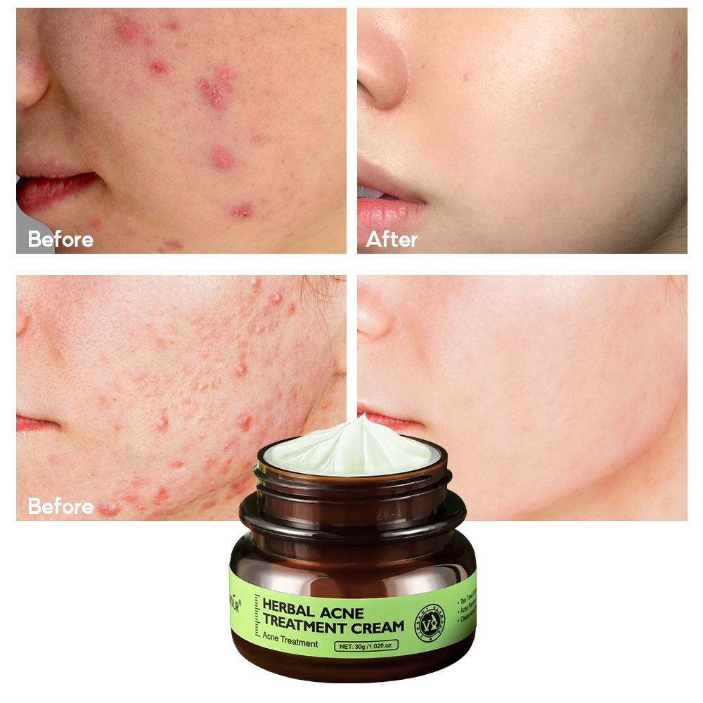 Kem hỗ trợ giảm mụn VIBRANT GLAMOUR chiết xuất tràm trà kiềm dầu dưỡng ẩm chăm sóc da 30g