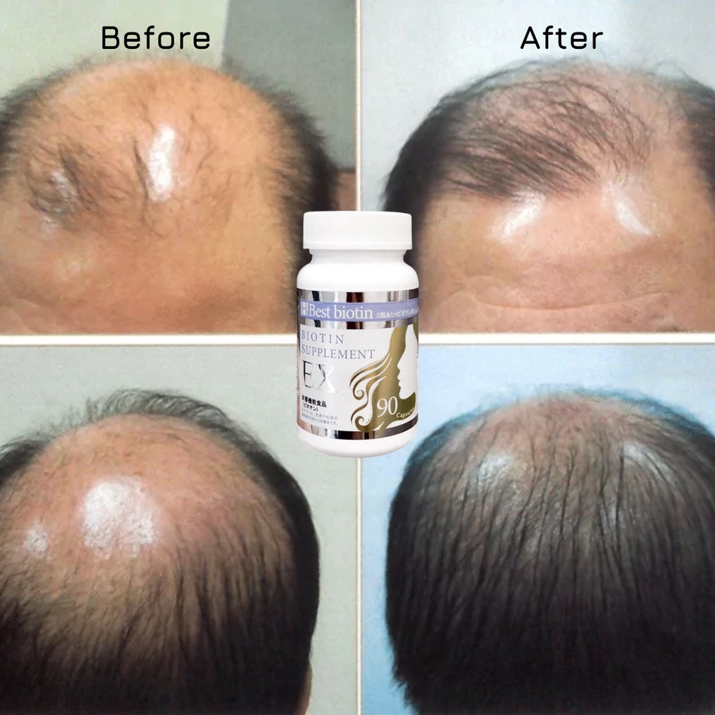 Viên Uống Hỗ Trợ Mọc Tóc Best Biotin Supplement EX - 90 Viên