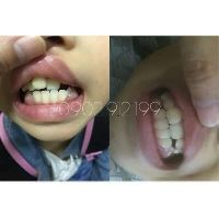 (A1+A2) Dụng cụ niềng răng cho trẻ em