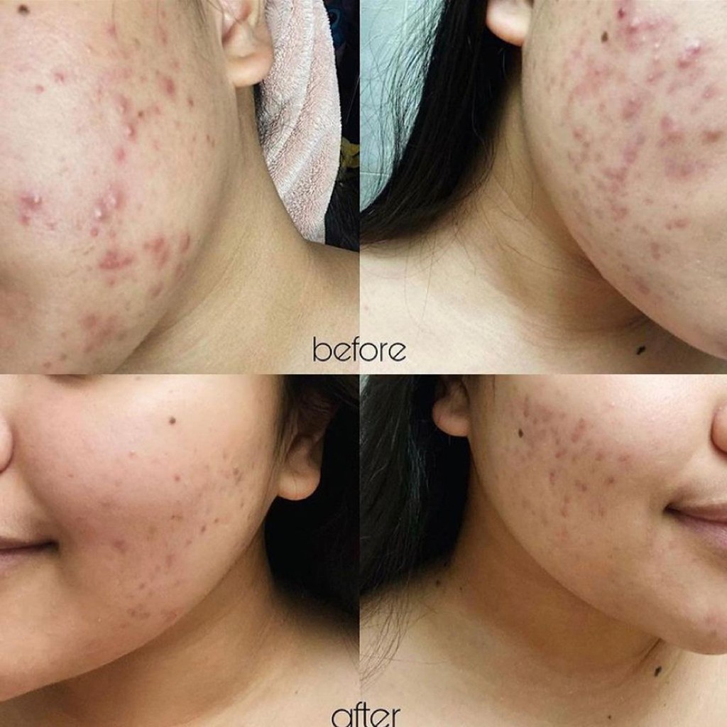 Kem Giảm Mụn Image Skincare Clear Cell Medicated Acne Lotion