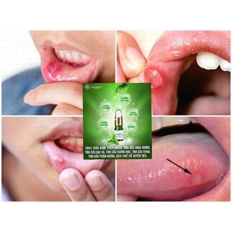 INOD Hôi Miệng Huyền Phi - Serum Tinh Dầu Răng Miệng Thơm Mát