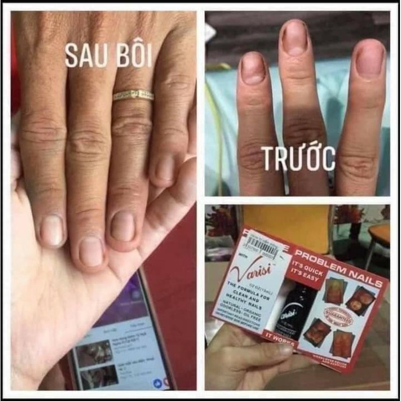 Điều trị nấm móng Varisi