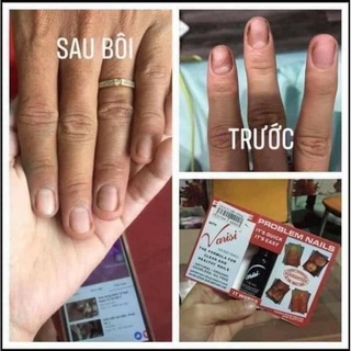 Điều trị nấm móng Varisi