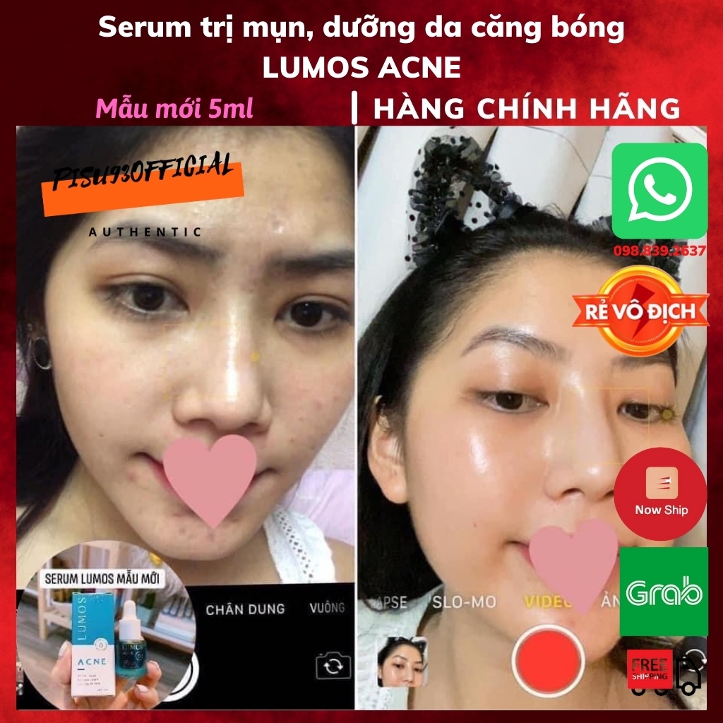 Serum LUMOS ACNE giảm mụn, mờ thâm nám