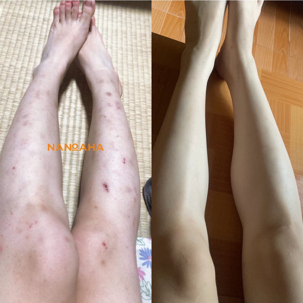 Serum Nano Aha  Khử Thâm Nano Aha - 7 Ngày Hiệu Quả