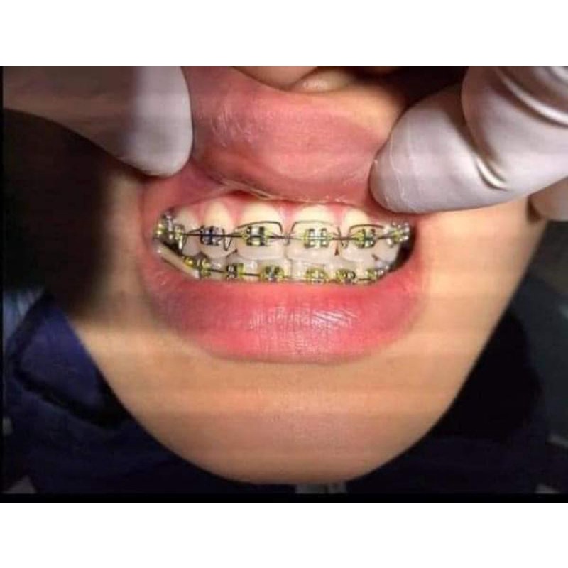 Lò xo ART chỉnh răng trước - Vật liệu chỉnh nha