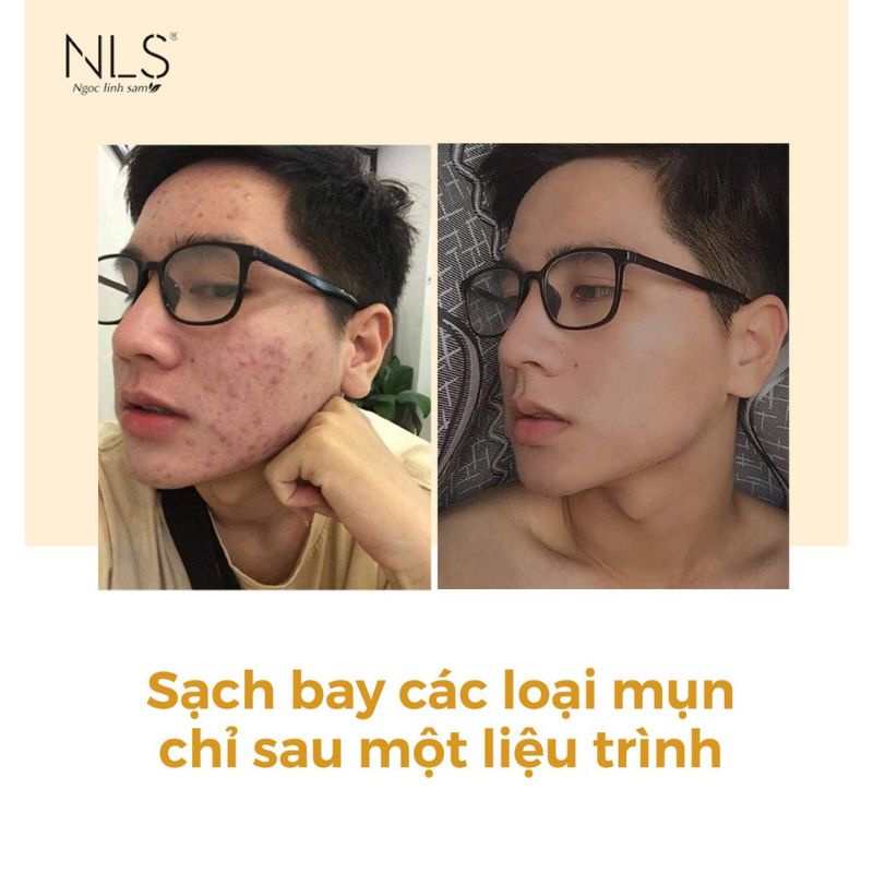 COMBO SERUM THẢO DƯỢC NGỌC LINH SÂM XÓA MỤN NÁM TÀN NHANG SẸO RỖ | BigBuy360 - bigbuy360.vn