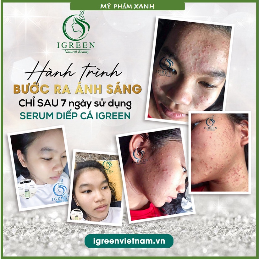 Serum diếp cá Igreen 10ml sạch mụn thâm se khít lỗ chân lông, nuôi dưỡng da căng bóng mịn màng