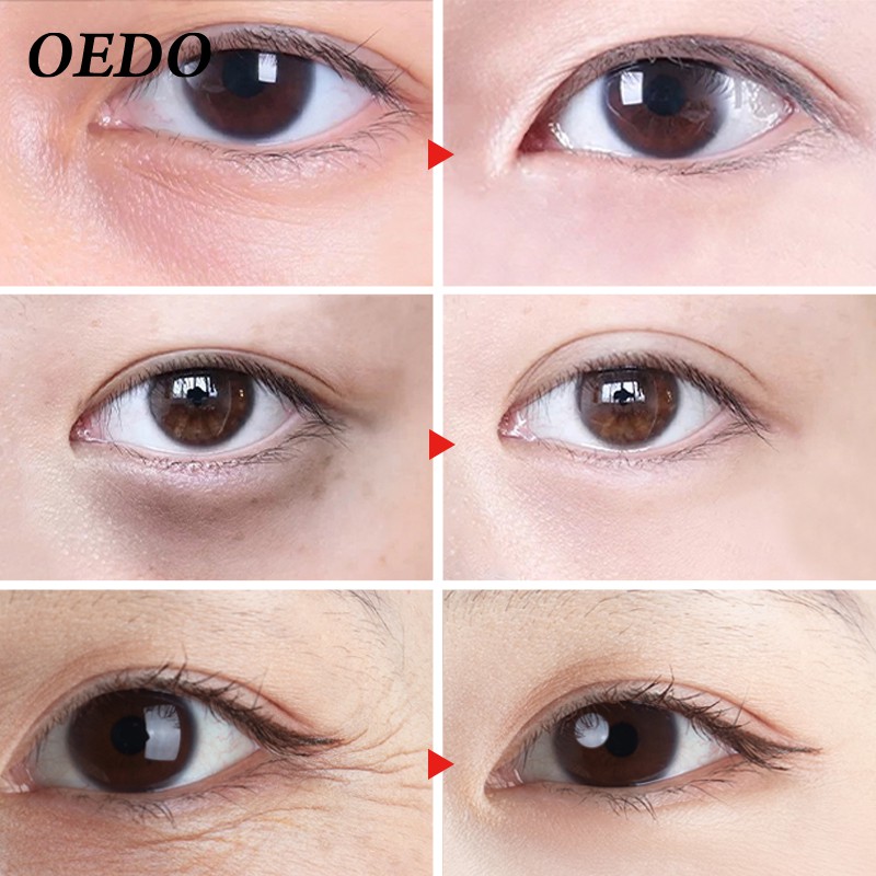 Set 2 mặt nạ mắt OEDO chống lão hóa làm mờ nếp nhăn chất lượng cao