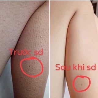 viêm lỗ chân lông kela lotion