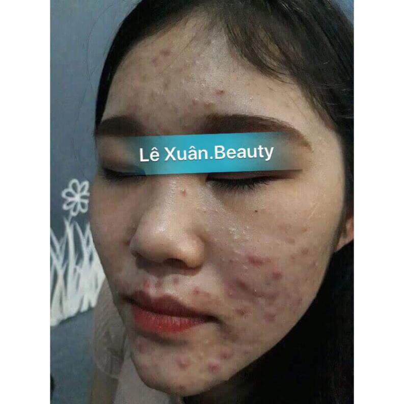 TINH CHẤT MỤN TRỨNG CÁ LÊ XUÂN💚FREESHIP💚Đánh bay mụn ẩn, mụn dầu đen, mụn trứng cá... sáng mịn da, khít lỗ chân lông | BigBuy360 - bigbuy360.vn