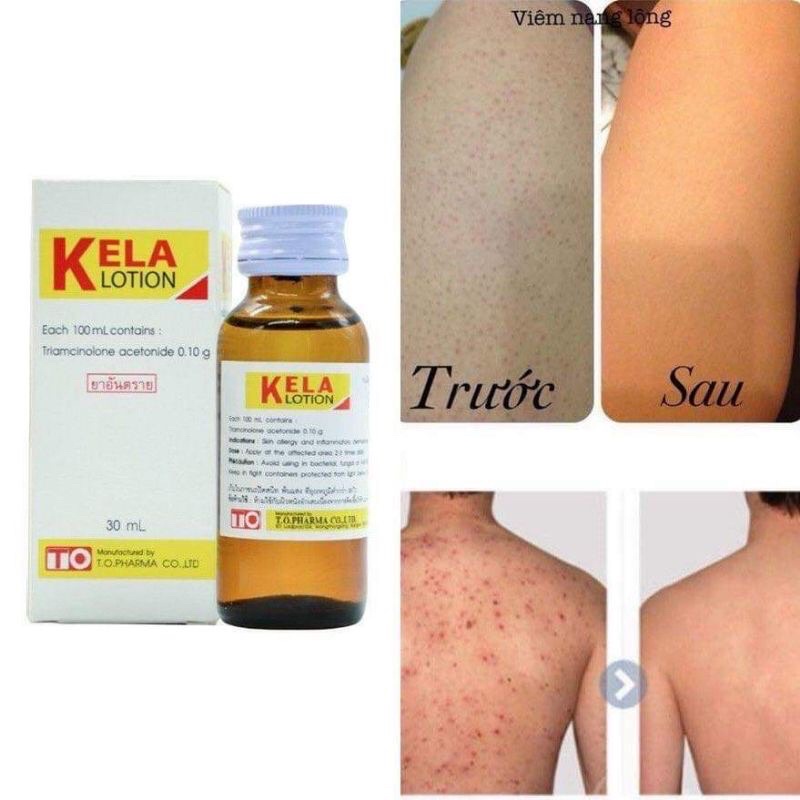 KELA LOTION DÙNG CHO VIÊM LỖ CHÂN LÔNG