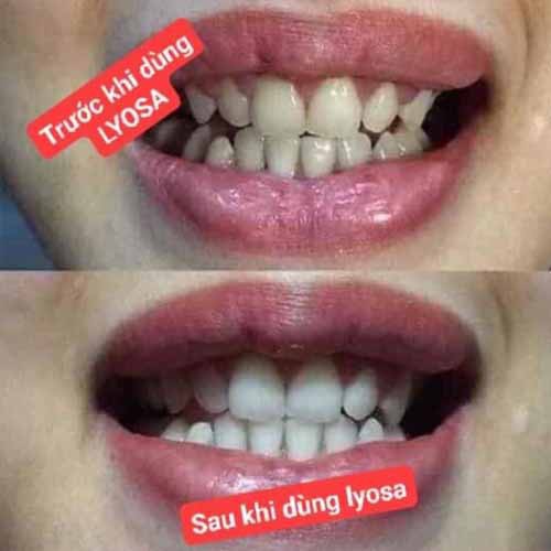 Bộ Kít Làm Trắng Răng Tại Nhà LYOSA MAGIC WHITE  An Toàn Tiện Lợi, Loại Bỏ Cao Răng, Hơi Thở Thơm Tho