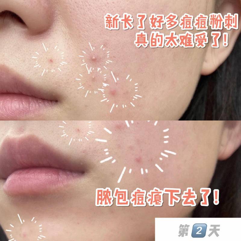 Hộp tăm bông cotton loại bỏ mụn trứng cá