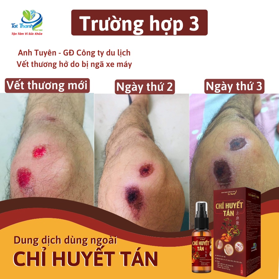 Dung dịch dùng ngoài Chỉ Huyết Tán Tất Thành Pharma xịt thảo dược làm dịu vết trầy xước 15ml