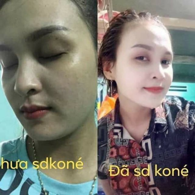 Bộ Kem KONÉ thái ( mẫu ảnh cuối )