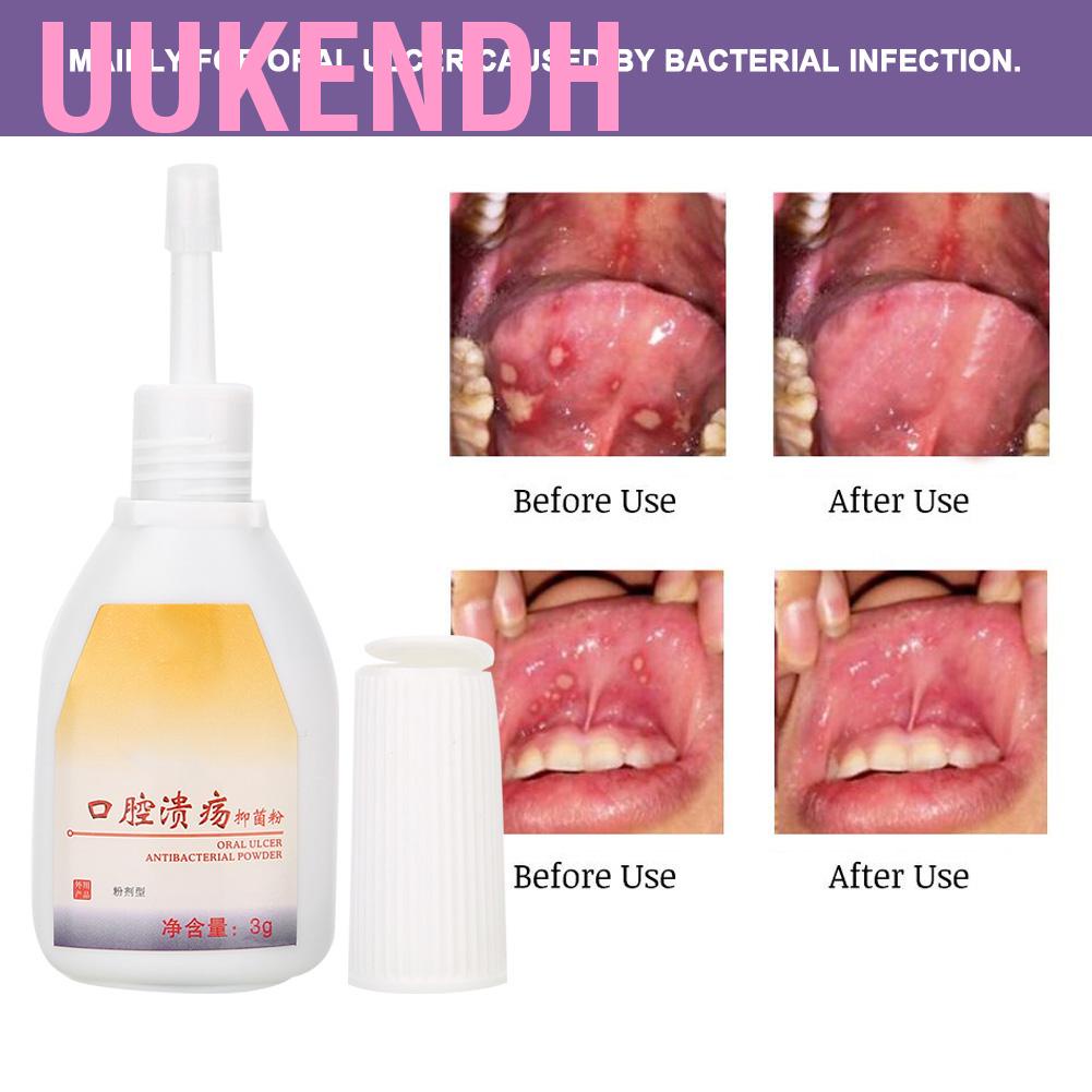 Uukendh Oral Ulcer Sore Relief Powder Mouth Ulcers Antibacterial Treatment Health Care
