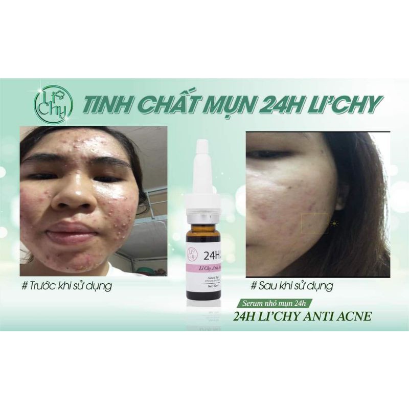 SERUM MỤN 24H LI'CHY [GÔM CÙI MỤN NHANH ]