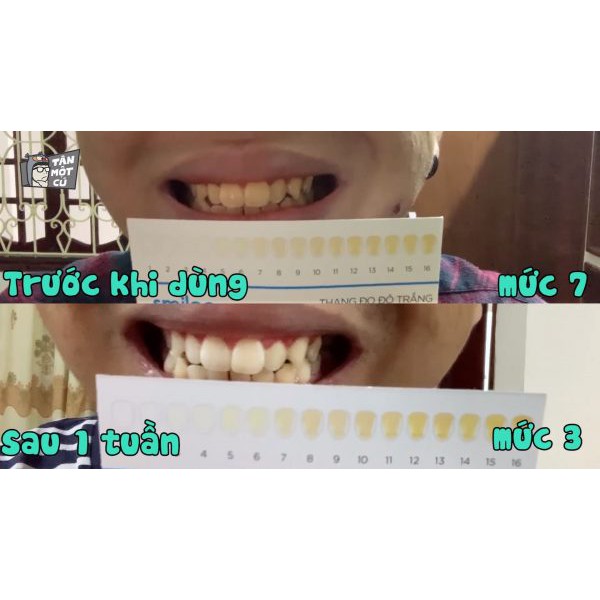[Hàng Chính Hãng ] Tẩy trắng răng tại nhà Smilee trong 7 ngày – nhập khẩu USA - Full Combo