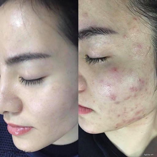 Tinh Chất Giảm Viêm Giảm Mụn Tức Thì Perilla Acne Spot ABISALAB