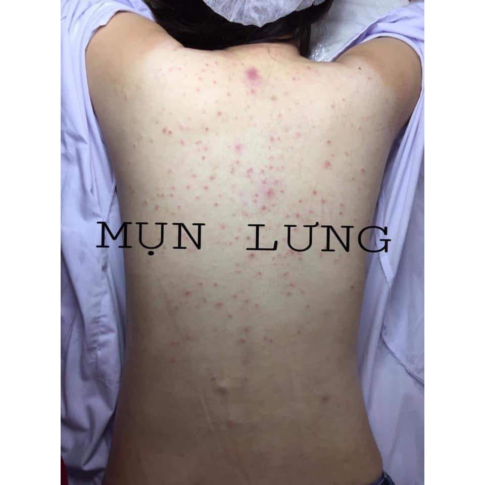 MEN VI SINH TAVIDA HẾT MỤN LƯNG, VIÊM NANG LÔNG, MẨN NGỨA | BigBuy360 - bigbuy360.vn