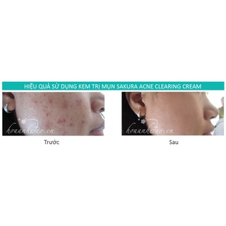 [DEAL SỐ]] Kem trị mụn Sakura Acne Clearing Cream 25ml