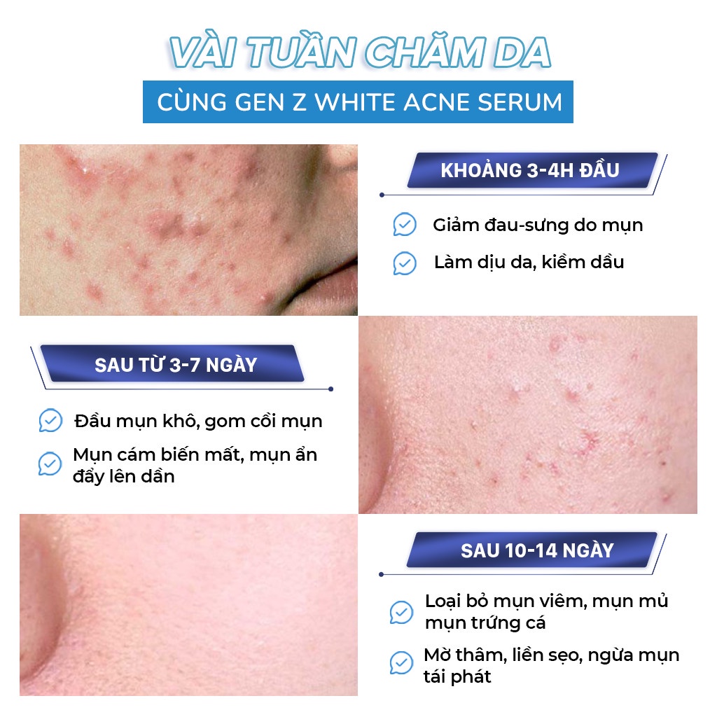 Serum Giảm Mụn Oriskin GenZ White Acne Serum Loại Bỏ Các Loại Mụn Viêm, Trứng Cá Và Mụn Đầu Đen 15ml