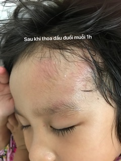 DẦU ĐUỔI MUỖI KIM