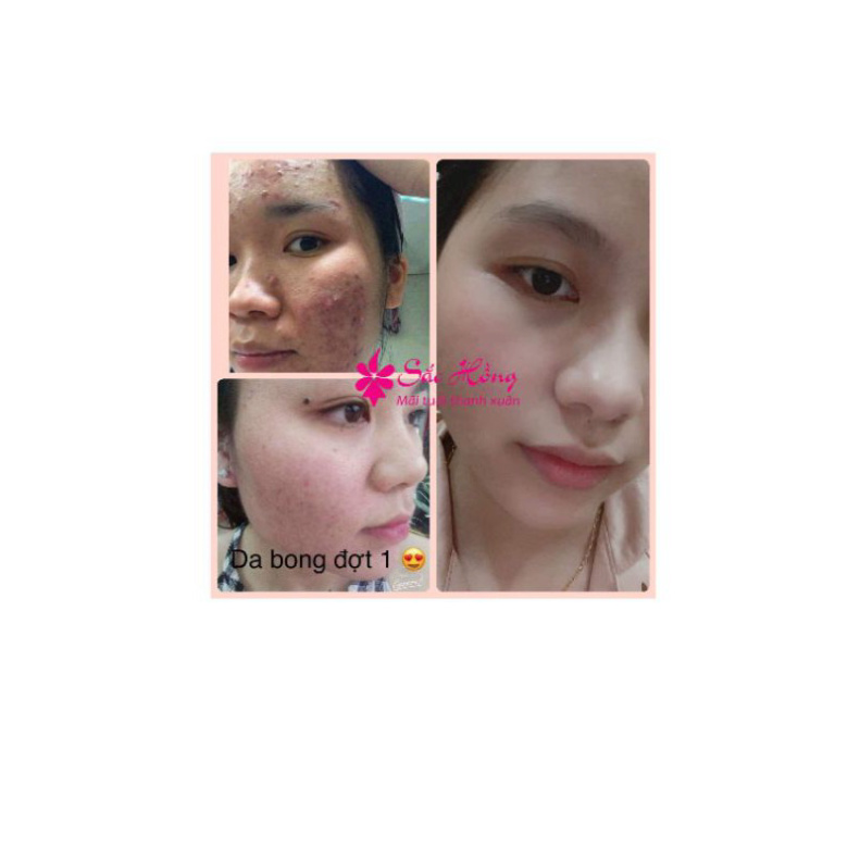 Serum Sắc Hồng cao cấp ngừa mụn - mờ nám 30ml