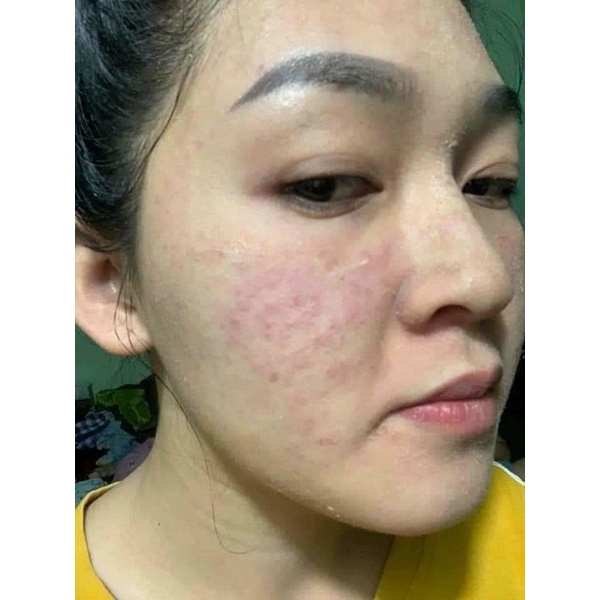 Serum Dày Da Phục Hồi Sau Tái Tạo KIM SPA