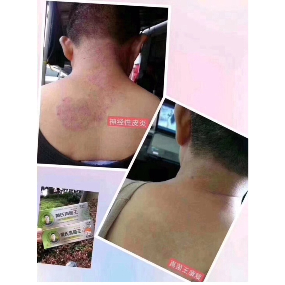 Kem bôi vẩy nến nấm đầu mẩn đỏ hăm ta chàm sữa