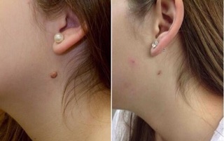 Tẩy nốt ruồi mụn cóc Nga