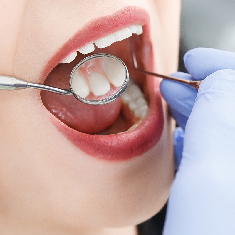 Bộ dụng cụ vệ sinh răng miệng hỗ trợ lấy cao răng và mảng bám