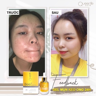 [Chính Hãng] GEL MỤN KEO ONG 24H