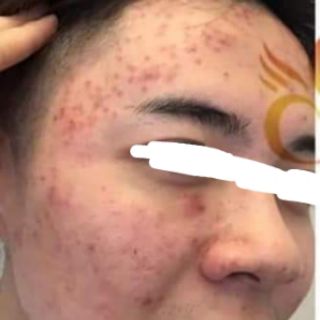 (💥CHÍNH HÃNG) Serum trị mụn Secret Life (hàng sẵn có).