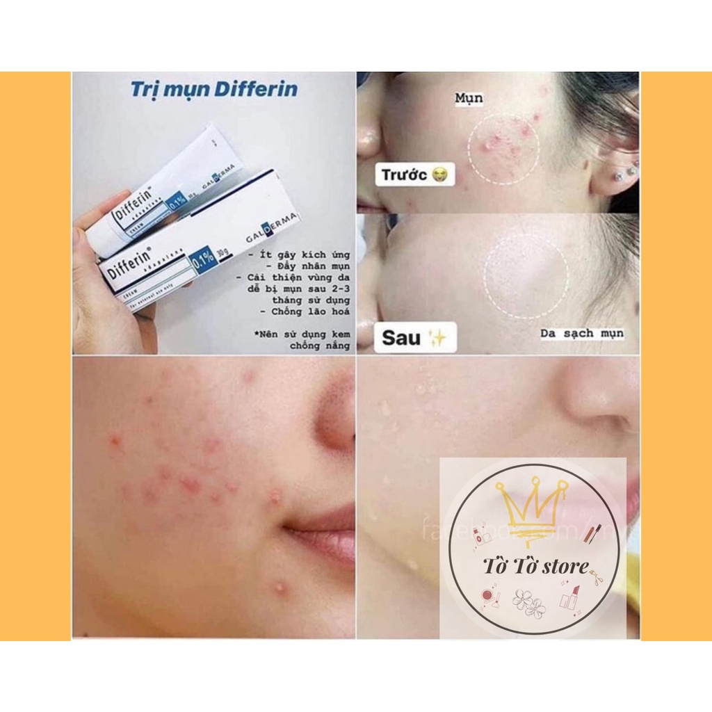 DIFFERIN CREAM CHÍNH HÃNG NỘI ĐỊA PHÁP [CÓ ẢNH THẬT] | BigBuy360 - bigbuy360.vn