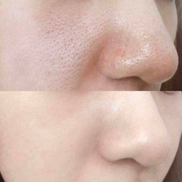 Tế Bào Gốc Pocia Thu Nhỏ Lỗ Chân Lông Căng Bóng Da Đẹp Da sau 1 lần sử dụng