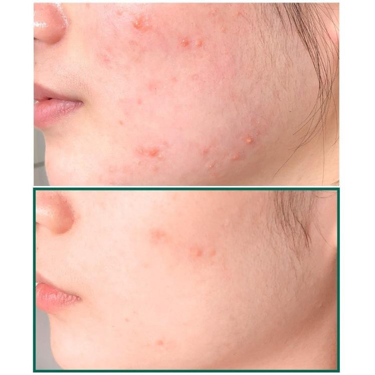 Hàng Hàn- Sữa Rửa Mặt &quot;Thần Kỳ&quot; Some By Mi AHA-BHA-PHA 30 Days Miracel Acne Clear Foam 100ml