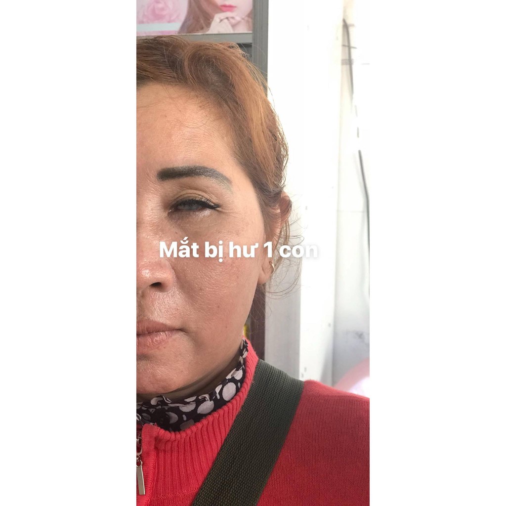 Kính Áp Tròng / Lens mắt THẨM MỸ che khuyết điểm khi bị tật 1 bên mắt