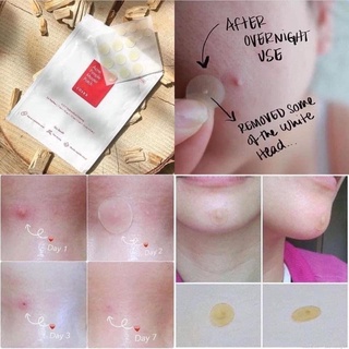 Miếng dán mụn Cosrx Acne Pimple Master Patch (Đỏ-Đen)