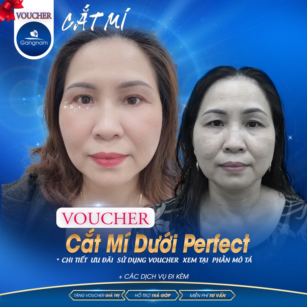 Cắt Mí Dưới Perfect | Thẩm Mỹ Viện Gangnam