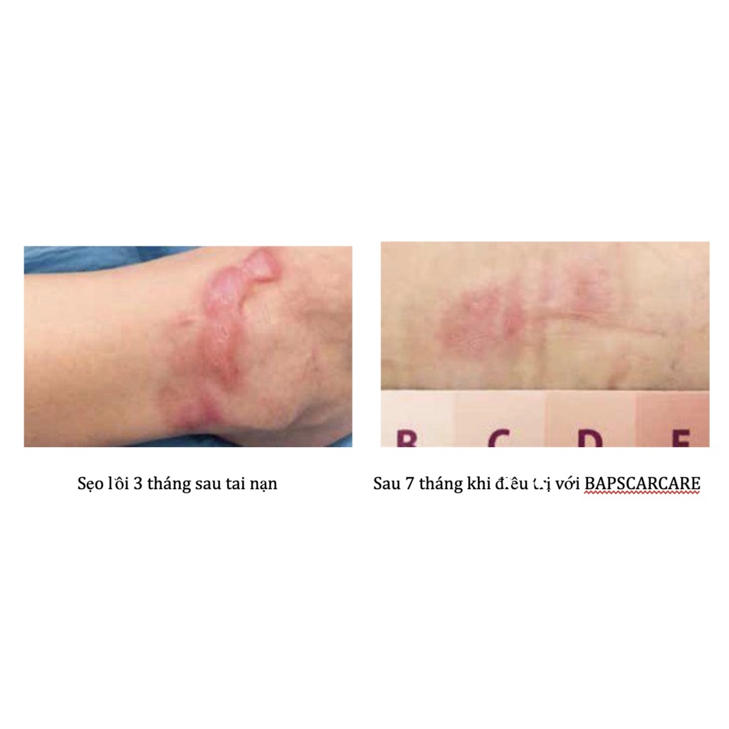 BAPSCARCARE - Gel làm mờ sẹo Silicone thế hệ mới