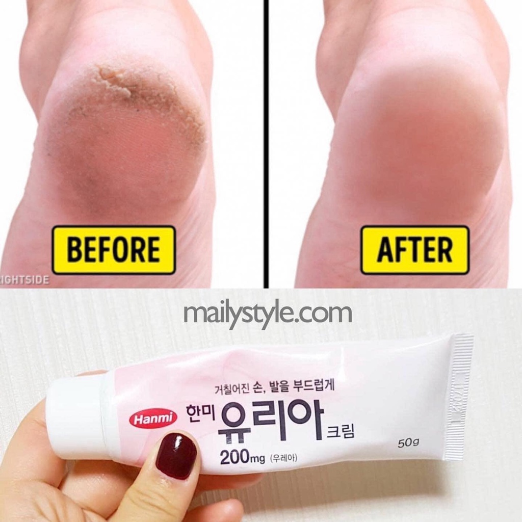 E83_Kem Hỗ Trợ Giảm Nứt Gót Chân, Nứt Ngón Tay- Tay Urea