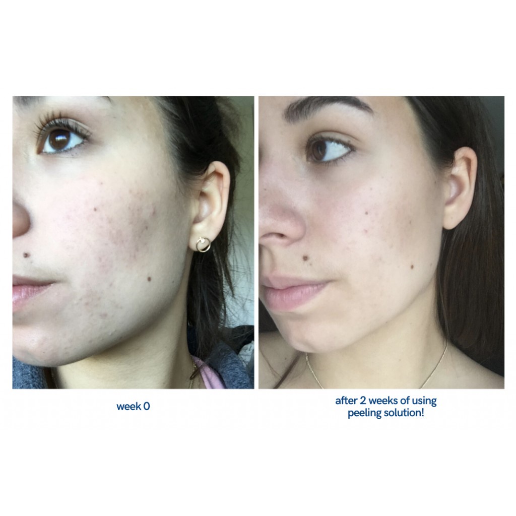 Tinh chất The Ordinary AHA 30% + BHA 2% Peeling Solution 30ml  - Peel da the ordinary - NAC beauty