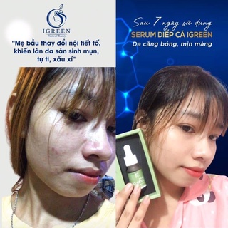 [HOT] COMBO TOÀN DIỆN CHO DA HẾT MỤN. HẾT THÂM ~ COMBO DIẾP CÁ ,