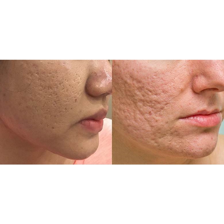Kem Nghệ Thái Dương (nano Bạc), Tuýp 20g Chính Hãng Giúp Giảm Mụn, Mờ Thâm Nám, Nhanh Mờ Sẹo - Mỹ Phẩm Ola